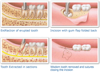Wisdom Teeth Removal - The Dental Centre